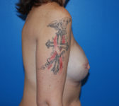Patient 75 - Surgery 3 Photo 5 - Breast Augmentation Tissue Expander Implant - Breast Cancer Texas