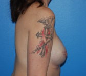 Patient 75 - Surgery 4 Photo 5 - Breast Augmentation Tissue Expander Implant - Breast Cancer Texas