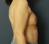 Patient 307 - 3D tattoo Photo 5 - DIEP Flap Surgery - Breast Cancer Texas