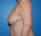 Patient 9 Before Surgey Photo 1 - Mastopexy Breast Reduction Lumpectomy Breast Reduction-Lift - Breast Cancer Texas