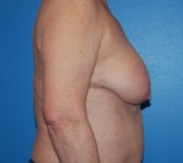 Patient 9 Before Surgey Photo 5 - Mastopexy Breast Reduction Lumpectomy Breast Reduction-Lift - Breast Cancer Texas