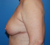Patient 9 - Surgery 1 Photo 1 - Mastopexy Breast Reduction Lumpectomy Breast Reduction-Lift - Breast Cancer Texas