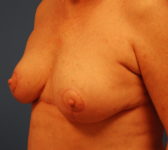 Patient 9 - Surgery 1 Photo 2 - Mastopexy Breast Reduction Lumpectomy Breast Reduction-Lift - Breast Cancer Texas