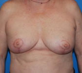 Patient 9 - Surgery 1 Photo 3 - Mastopexy Breast Reduction Lumpectomy Breast Reduction-Lift - Breast Cancer Texas