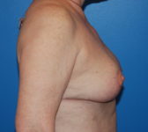 Patient 9 - Surgery 1 Photo 5 - Mastopexy Breast Reduction Lumpectomy Breast Reduction-Lift - Breast Cancer Texas