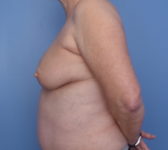 Patient 9 - Surgery 2 Photo 1 - Mastopexy Breast Reduction Lumpectomy Breast Reduction-Lift - Breast Cancer Texas