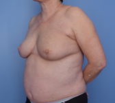 Patient 9 - Surgery 2 Photo 2 - Mastopexy Breast Reduction Lumpectomy Breast Reduction-Lift - Breast Cancer Texas