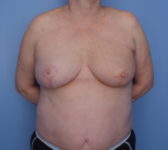 Patient 9 - Surgery 2 Photo 3 - Mastopexy Breast Reduction Lumpectomy Breast Reduction-Lift - Breast Cancer Texas