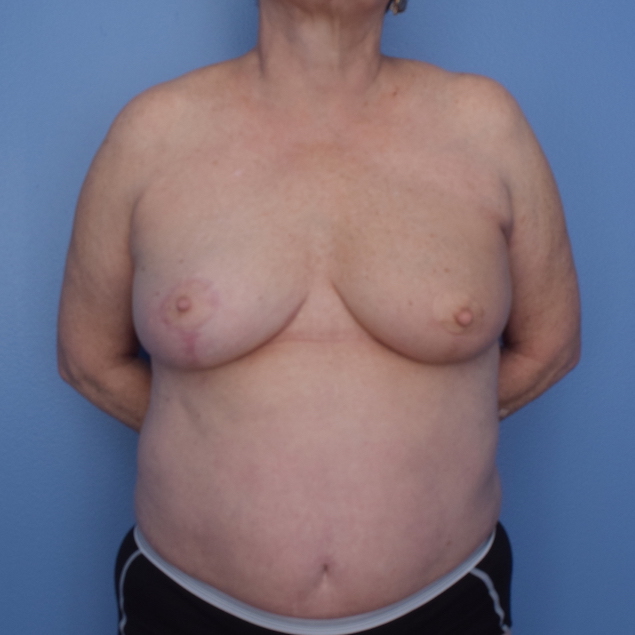 Patient 9 After Overview - Mastopexy Breast Reduction Lumpectomy Breast Reduction-Lift - Breast Cancer Texas
