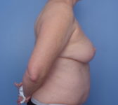 Patient 9 - Surgery 2 Photo 5 - Mastopexy Breast Reduction Lumpectomy Breast Reduction-Lift - Breast Cancer Texas
