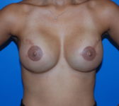 Patient 211 - Surgery 3 Photo 3 - Tissue Expander Implant - Breast Cancer Texas