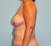 Patient 201 Before Surgey Photo 1 - Mastopexy DIEP Flap Surgery - Breast Cancer Texas