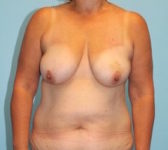 Patient 201 Before Surgey Photo 3 - Mastopexy DIEP Flap Surgery - Breast Cancer Texas