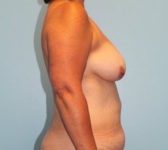 Patient 201 Before Surgey Photo 5 - Mastopexy DIEP Flap Surgery - Breast Cancer Texas