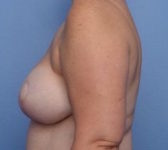 Patient 201 - Mastectomy and Immediate DIEP flap reconstruction Photo 1 - Mastopexy DIEP Flap Surgery - Breast Cancer Texas