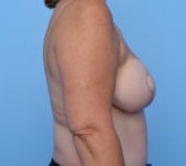 Patient 201 - Mastectomy and Immediate DIEP flap reconstruction Photo 5 - Mastopexy DIEP Flap Surgery - Breast Cancer Texas