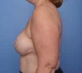 Patient 201 - Surgery 2 Photo 1 - Mastopexy DIEP Flap Surgery - Breast Cancer Texas