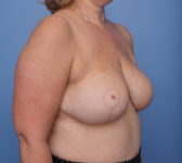 Patient 201 - Surgery 2 Photo 4 - Mastopexy DIEP Flap Surgery - Breast Cancer Texas