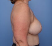 Patient 201 - Surgery 2 Photo 5 - Mastopexy DIEP Flap Surgery - Breast Cancer Texas