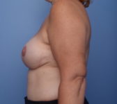 Patient 201 - 3D tattoo Photo 1 - Mastopexy DIEP Flap Surgery - Breast Cancer Texas