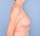Patient 754 - Surgery 2 Photo 5 - Nipple Sparing Mastectomy Tissue Expander Implant - Breast Cancer Texas