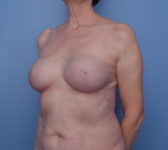 Patient 754 - Surgery 1 Photo 2 - Nipple Sparing Mastectomy Tissue Expander Implant - Breast Cancer Texas
