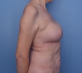 Patient 754 - Surgery 1 Photo 5 - Nipple Sparing Mastectomy Tissue Expander Implant - Breast Cancer Texas