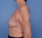Patient 754 Before Surgey Photo 1 - Nipple Sparing Mastectomy Tissue Expander Implant - Breast Cancer Texas