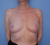 Patient 754 Before Overview - Nipple Sparing Mastectomy Tissue Expander Implant - Breast Cancer Texas