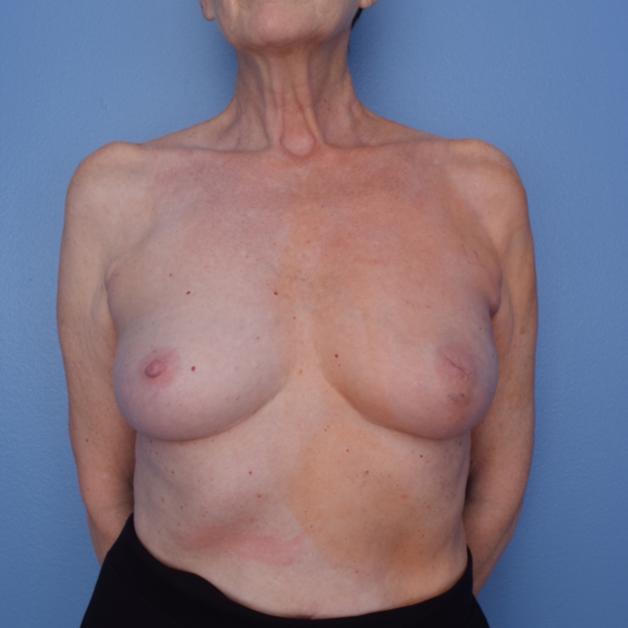 Patient 754 Before Overview - Sidebar - Nipple Sparing Mastectomy Tissue Expander Implant - Breast Cancer Texas