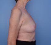 Patient 754 Before Surgey Photo 5 - Nipple Sparing Mastectomy Tissue Expander Implant - Breast Cancer Texas