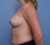 Patient 476 Before Surgey Photo 1 - Nipple Sparing Mastectomy Tissue Expander Implant - Breast Cancer Texas