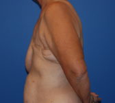 Patient 555 Before Surgey Photo 1 - Mastopexy DIEP Flap Surgery - Breast Cancer Texas