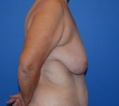 Patient 555 Before Surgey Photo 5 - Mastopexy DIEP Flap Surgery - Breast Cancer Texas