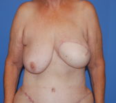 Patient 555 - Surgery 1 Photo 3 - Mastopexy DIEP Flap Surgery - Breast Cancer Texas
