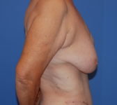 Patient 555 - Surgery 1 Photo 5 - Mastopexy DIEP Flap Surgery - Breast Cancer Texas