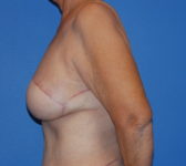 Patient 555 - Surgery 2 Photo 1 - Mastopexy DIEP Flap Surgery - Breast Cancer Texas