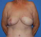 Patient 555 - Surgery 2 Photo 3 - Mastopexy DIEP Flap Surgery - Breast Cancer Texas