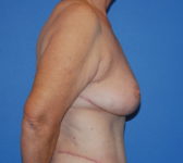 Patient 555 - Surgery 2 Photo 5 - Mastopexy DIEP Flap Surgery - Breast Cancer Texas