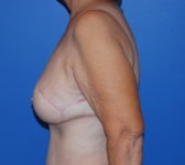 Patient 555 - Surgery 3 Photo 1 - Mastopexy DIEP Flap Surgery - Breast Cancer Texas