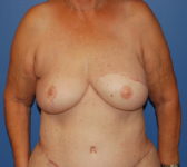 Patient 555 - Surgery 3 Photo 3 - Mastopexy DIEP Flap Surgery - Breast Cancer Texas