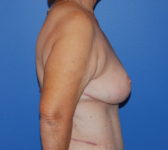 Patient 555 - Surgery 3 Photo 5 - Mastopexy DIEP Flap Surgery - Breast Cancer Texas