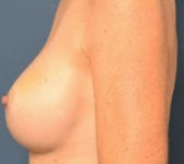 Patient 53 Before Surgey Photo 1 - Nipple Sparing Mastectomy Tissue Expander Implant - Breast Cancer Texas