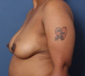 Patient 291 Before Surgey Photo 1 - DIEP Flap Surgery - Breast Cancer Texas