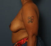 Patient 291 - 1 year after completion of reconstruction Photo 1 - DIEP Flap Surgery - Breast Cancer Texas
