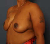 Patient 291 - 1 year after completion of reconstruction Photo 2 - DIEP Flap Surgery - Breast Cancer Texas