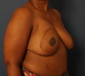 Patient 291 - 1 year after completion of reconstruction Photo 4 - DIEP Flap Surgery - Breast Cancer Texas