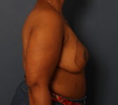 Patient 291 - 1 year after completion of reconstruction Photo 5 - DIEP Flap Surgery - Breast Cancer Texas