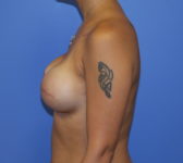 Patient 691 - Surgery 1 Photo 1 - Tissue Expander Implant - Breast Cancer Texas