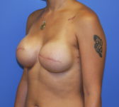 Patient 691 - Surgery 1 Photo 2 - Tissue Expander Implant - Breast Cancer Texas